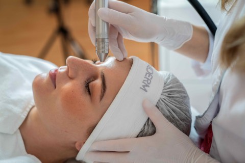 Micro-Needling Behandlung an der Stirn